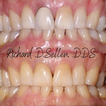 Richard D Sellen, DDS - With the help from our Master Ceramist we were able to make this patient's front crown (cap) blend in perfectly. - Cosmetic Dentists Near Me - San Jose, California Richard D Sellen, DDS - With the help from our Master Ceramist we were able to make this patient's front crown (cap) blend in perfectly. - Cosmetic Dentists Near Me - San Jose, California