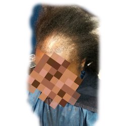Beauty Personified Weaving and Hair Loss Clinic - Before 360 frontal installation for Alopecia