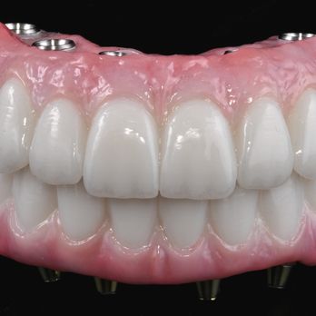 GIE Dental Laboratory - All-on-6 and all-on-4 fixed CeraZi bridges - General Dentistry Near Me - Glendale, California GIE Dental Laboratory - All-on-6 and all-on-4 fixed CeraZi bridges - General Dentistry Near Me - Glendale, California