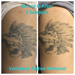 Removery Tattoo Removal & Fading