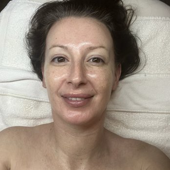 Aesthera MedSpa - Took "before" and "after" photos (AFTER) - Medical Spas Near Me - Pismo Beach, California Aesthera MedSpa - Took "before" and "after" photos (AFTER) - Medical Spas Near Me - Pismo Beach, California