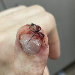 South County Urgent Care - Ooooh she nasty-lookin but Doc says it's healing well.