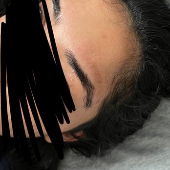 Brow Society NYC - Burnt and scaring skin - Eyebrow Services Near Me - New York, New York