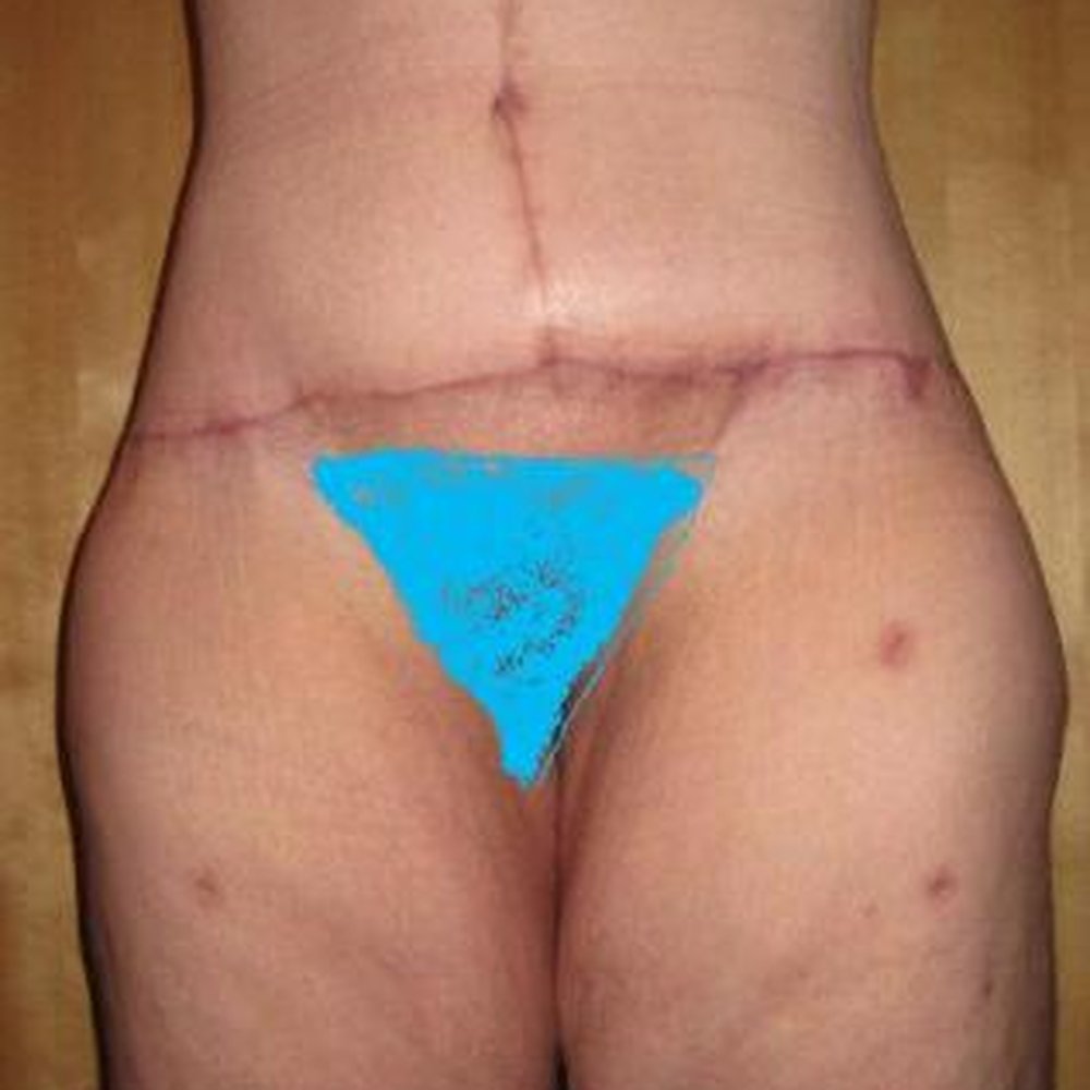 2 months post extended abdominoplasty and thigh liposuction.