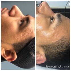 Microchanneling for acne scarring with bone derived stem cell before and after photo.