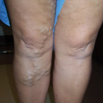 Legacy Vein Clinic - Patient 4 - varicose vein treatment BEFORE - Radiologists Near Me - Mishawaka, Indiana Legacy Vein Clinic - Patient 4 - varicose vein treatment BEFORE - Radiologists Near Me - Mishawaka, Indiana