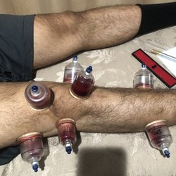 Certified Hijama-Cupping by Husain Abdul-Wahaab