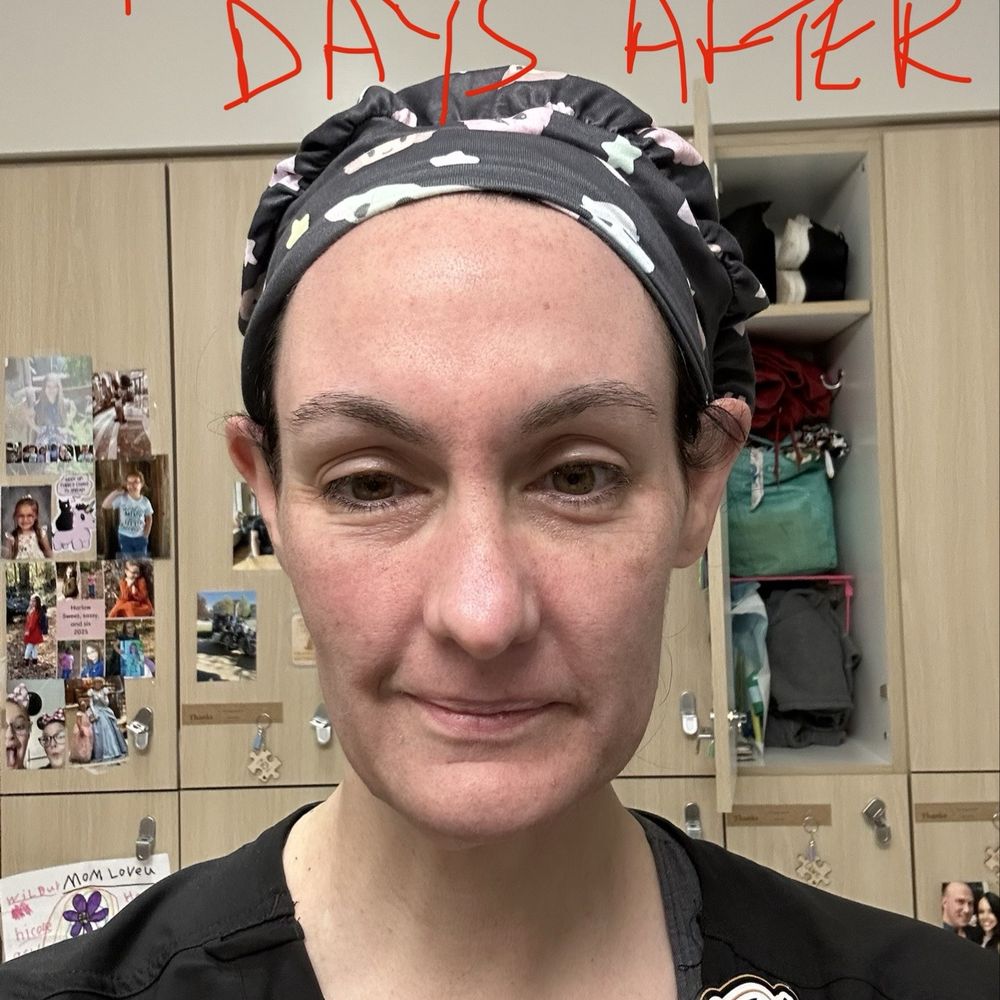 Turkle & Associates - 2 days after first treatment - Cosmetic Surgeons Near Me - Carmel, Indiana