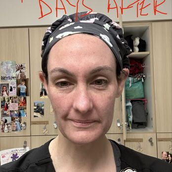 Turkle & Associates - 2 days after first treatment - Cosmetic Surgeons Near Me - Carmel, Indiana