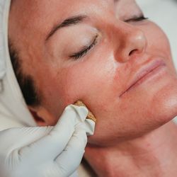 Derma Health Skin & Laser - We offer a variety of Chemical Peels for various skin types and concerns.