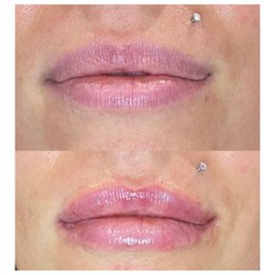 Signature Aesthetics & IV Lounge - Lip filler- our goal with injections is to treat what concerns you!