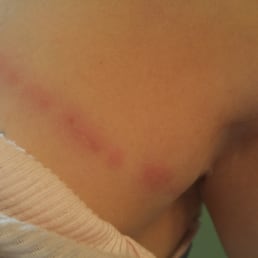 Bed bug bites. Bed bug bites.