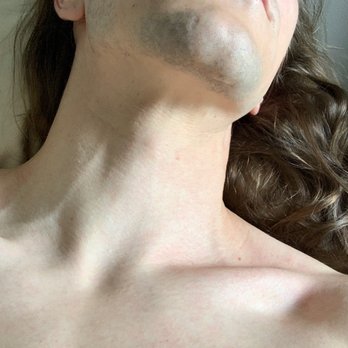 Satori Laser - Union Square - Treatment results - Laser Hair Removal Near Me - New York, New York Satori Laser - Union Square - Treatment results - Laser Hair Removal Near Me - New York, New York