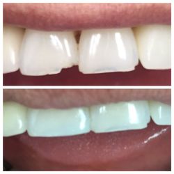 Deerfield Family Dental - Bonding to fix chipped tooth in the left