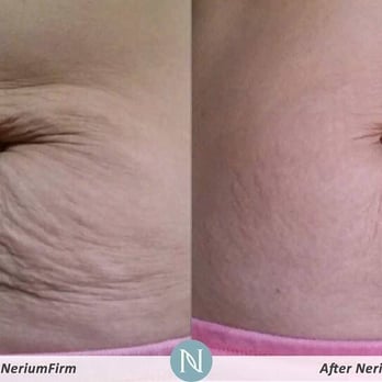 Youthful Skin Revealed - Real results with Nerium Firm - Skin Care Near Me Youthful Skin Revealed - Real results with Nerium Firm - Skin Care Near Me