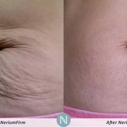 Youthful Skin Revealed - Real results with Nerium Firm