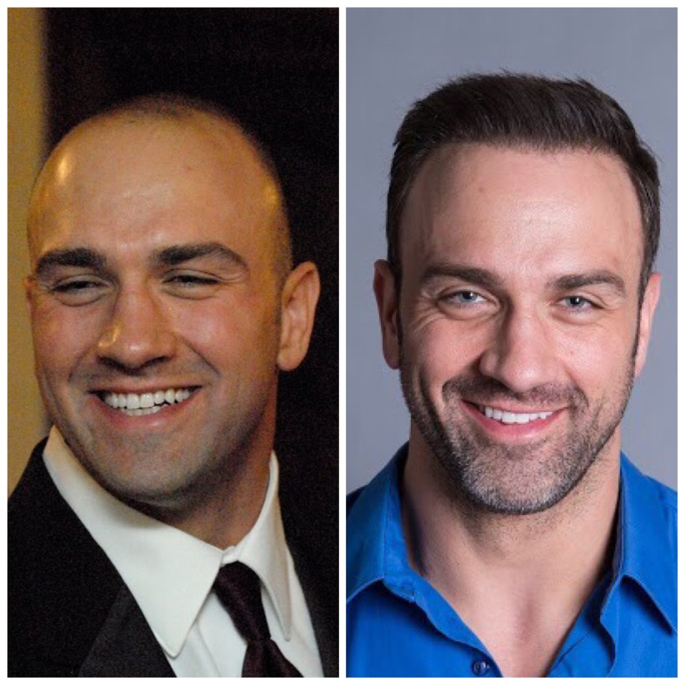 Bosley Hair Transplant Restoration 47 Photos Hair Loss