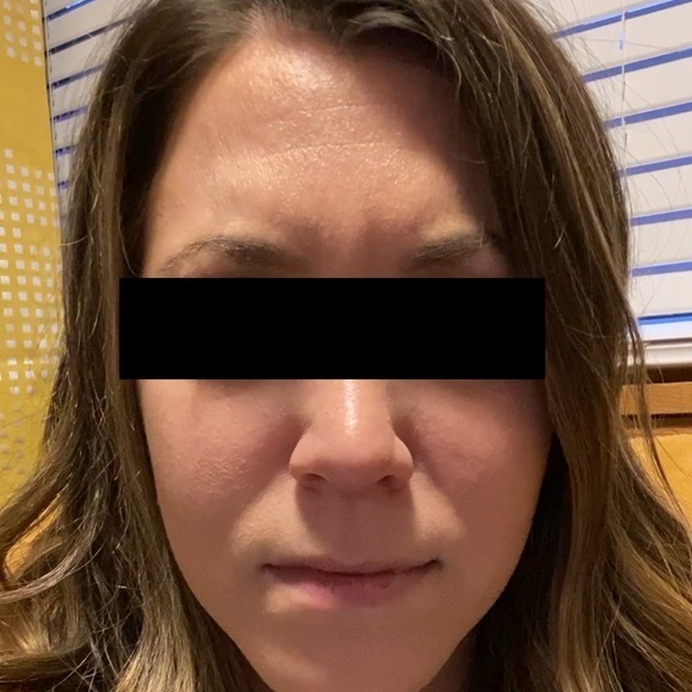 Accentuate Med Spa - After Botox furrowing my eyebrows. Again, still some movement, but visibly reduced creasing. - Medical Spas Near Me - Mount Holly, North Carolina