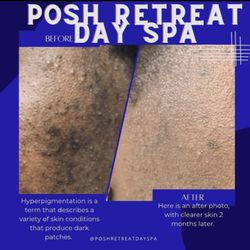 Posh Retreat Day Spa - This picture consist of a number of chemical peels and microdermabrasion facials with home care.