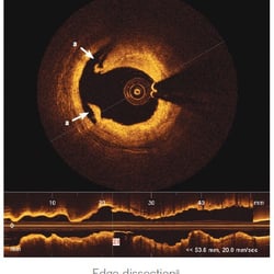 Arizona Heart Specialists - Peeling of the inside of the coronary artery as a result of  ruptured cholesterol plaque. Blood clots over it causing a heart attack.