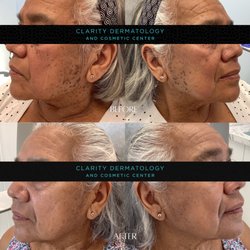 Clarity Dermatology and Cosmetic Center - These are before and after photos of a patient who underwent cosmetic treatment for her age spots after only one session with Dr. Yuri Kim.