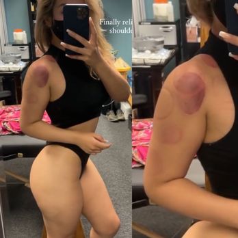 Thainamic Bodywork & Relaxation - Post cupping / Thai massage w owner Allan! - Massage Therapy Near Me - San Diego, California