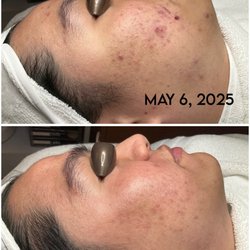 Clear Day Acne Clinic - His goal was to get clear over the summer - and he did!