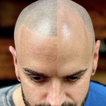 Density Ink - Another halfway point of a new clients first session. Game Changer! - Hair Loss Centers Near Me - Las Vegas, Nevada Density Ink - Another halfway point of a new clients first session. Game Changer! - Hair Loss Centers Near Me - Las Vegas, Nevada