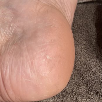 Cali Nails Hillside - Left heal. You can see how the grater cut the skin. - Nail Salons Near Me - Victoria, British Columbia Cali Nails Hillside - Left heal. You can see how the grater cut the skin. - Nail Salons Near Me - Victoria, British Columbia
