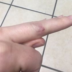 Quick Care Med - Two weeks later almost healed (90%)