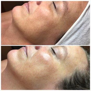 Lux Skin Studio - Dermaglow with enzyme and hydrating treatment - Skin Care Near Me - Boulder City, Nevada Lux Skin Studio - Dermaglow with enzyme and hydrating treatment - Skin Care Near Me - Boulder City, Nevada