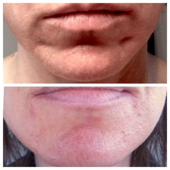 Body Tonic Aesthetics & Wellnesss - Before: bad dimples & shadowing! After: TOTALLY GONE! - Medical Spas Near Me - Austin, Texas Body Tonic Aesthetics & Wellnesss - Before: bad dimples & shadowing! After: TOTALLY GONE! - Medical Spas Near Me - Austin, Texas