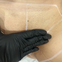 EBG Laser Hair Removal Studio - Here's a photo of a first time Brazilian session. On the left is right after treatment. On the right is before treatment.