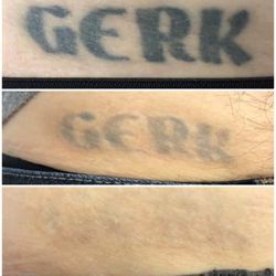 MEDermis Tattoo Removal - Before and after 5 laser treatments