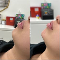 JTN Aesthetics - : Chin : Juvederm Voluma : $800 Done by Nurse Joanna  Medical Director: Dr. Michael Cerni