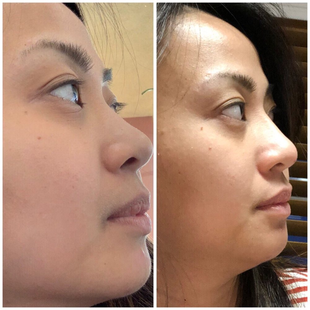 Venus MD - Before and after. (Look at that nose bridge haha!!) - Laser Hair Removal Near Me - Huntington Beach, California Venus MD - Before and after. (Look at that nose bridge haha!!) - Laser Hair Removal Near Me - Huntington Beach, California