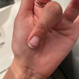 Where the line of blood is is my finger nail about to fall off Where the line of blood is is my finger nail about to fall off