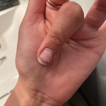 Venetian Nail Spa - Where the line of blood is is my finger nail about to fall off - Nail Salons Near Me - Hendersonville, Tennessee Venetian Nail Spa - Where the line of blood is is my finger nail about to fall off - Nail Salons Near Me - Hendersonville, Tennessee