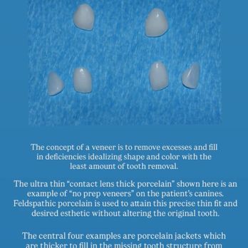 Cynthia Stephenson, DDS - Veneers can be very thin and conservative If planned correctly, can last and be the most beautiful- conserving natural tooth structure. - General Dentistry Near Me - Walnut Creek, California Cynthia Stephenson, DDS - Veneers can be very thin and conservative If planned correctly, can last and be the most beautiful- conserving natural tooth structure. - General Dentistry Near Me - Walnut Creek, California