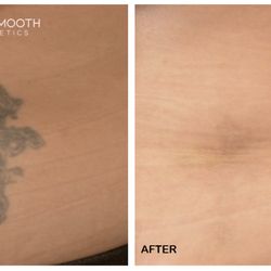 Baby Smooth Aesthetics - Our pico laser treatments are designed to target a range of skin concerns, including dark spots, melasma, hyperpigmentation and even tattoos