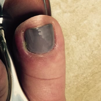 Nails Spa - Cellulitis Infection from my pedicure 2/28, picture taken 3/3 after visiting Doctor. Being treated with antibiotics used for staph/mrsa. - Nail Salons Near Me - Houston, Texas