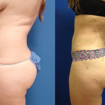 Los Angeles Liposuction Centers - UltraSculpt with enhanced safety, fast recover, and natural looking results. - Cosmetic Surgeons Near Me - Encino, California Los Angeles Liposuction Centers - UltraSculpt with enhanced safety, fast recover, and natural looking results. - Cosmetic Surgeons Near Me - Encino, California