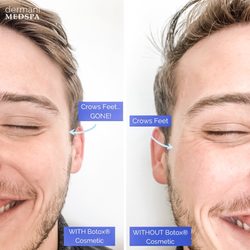 dermani MEDSPA® Johns Creek - Botox Cosmetic results