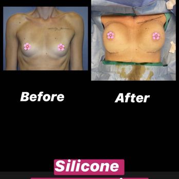 Troy J. Andreasen M.D - Before and after - Cosmetic Surgeons Near Me - Bldg #3 Ontario, California Troy J. Andreasen M.D - Before and after - Cosmetic Surgeons Near Me - Bldg #3 Ontario, California