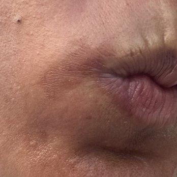 Nina's Shahnaz Herbal Salon & Spa - Day 2 - Skin burn after wax treatment - Threading Services Near Me - Commack, New York Nina's Shahnaz Herbal Salon & Spa - Day 2 - Skin burn after wax treatment - Threading Services Near Me - Commack, New York