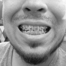 Benham Orthodontics - 1 year into treatment