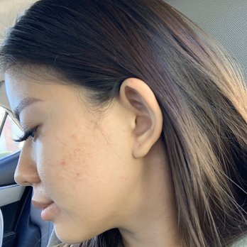 AWESTHETICS - Skin congested before facial - Skin Care Near Me - Huntington Beach, California AWESTHETICS - Skin congested before facial - Skin Care Near Me - Huntington Beach, California