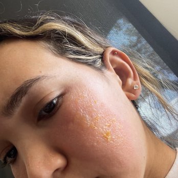 Face Haus - Infection: Impetigo from Face Haus facial - Waxing Near Me - Dallas, Texas Face Haus - Infection: Impetigo from Face Haus facial - Waxing Near Me - Dallas, Texas