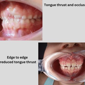 Arrowhead Myo - No longer tongue thrusts! - Naturopathic/Holistic Near Me Arrowhead Myo - No longer tongue thrusts! - Naturopathic/Holistic Near Me