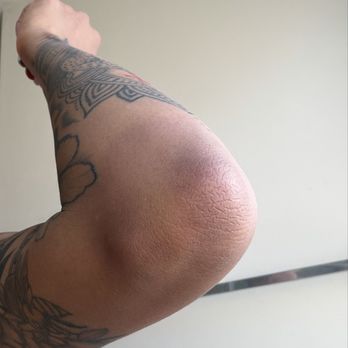 King Tut Hookah Lounge - bruises (elbow) in addition to head, jaw, and neck bruises - Hookah Bars Near Me - Charlotte, North Carolina King Tut Hookah Lounge - bruises (elbow) in addition to head, jaw, and neck bruises - Hookah Bars Near Me - Charlotte, North Carolina